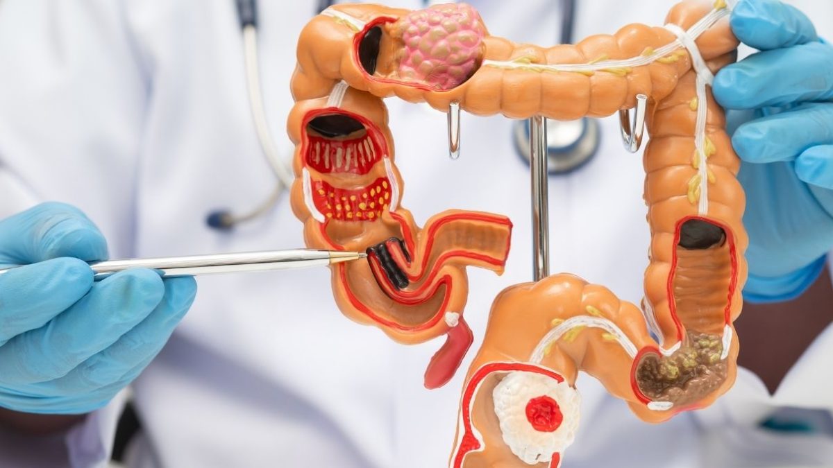 Uruguay refuerza prevención contra el cáncer de colon